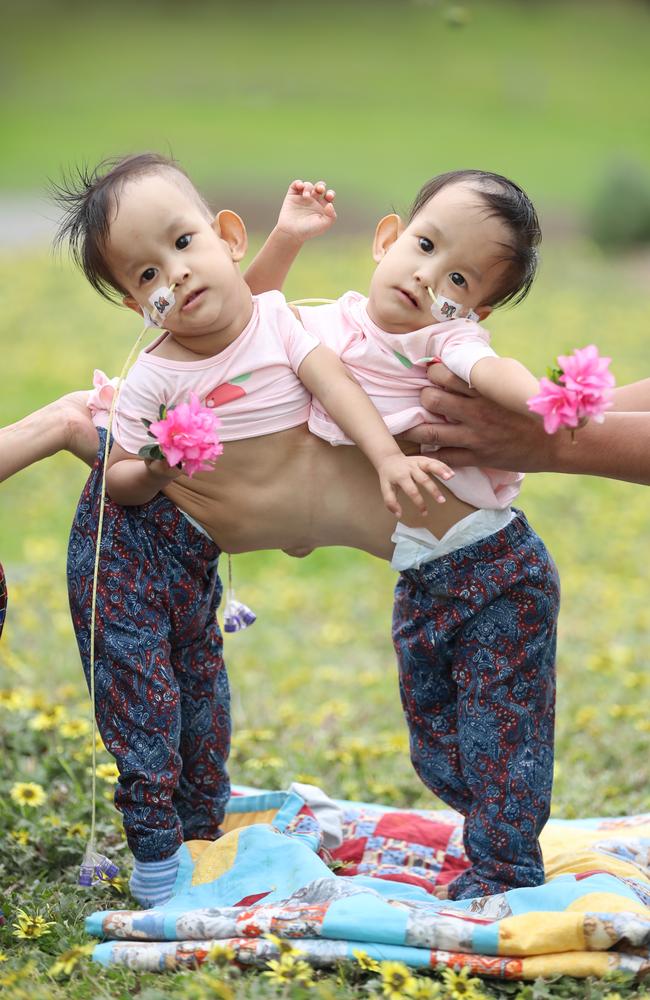 Bhutanese conjoined twins Nima and Dawa enjoy the fresh air outside in the grounds of the Children First Foundation Miracle Smiles Retreat in Kilmore. Picture: Alex Coppel