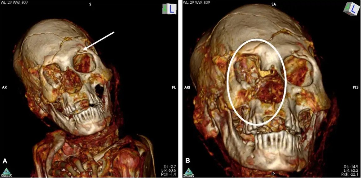 CT Scans Reveal Gnarly, 1,000-Year-Old Mummies Were Murdered