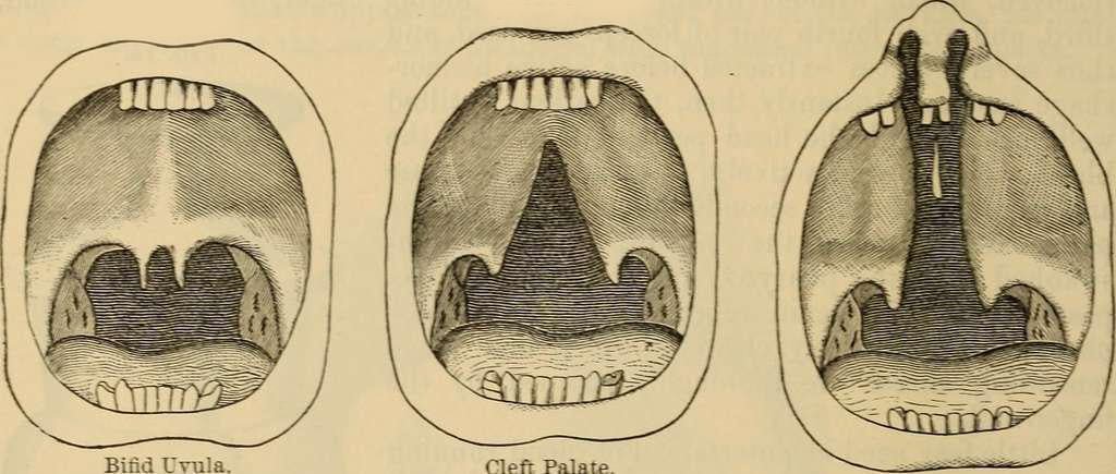 300-year-old prosthesis of gold, silver, and wool helps 18th-century man live with cleft palate in Poland