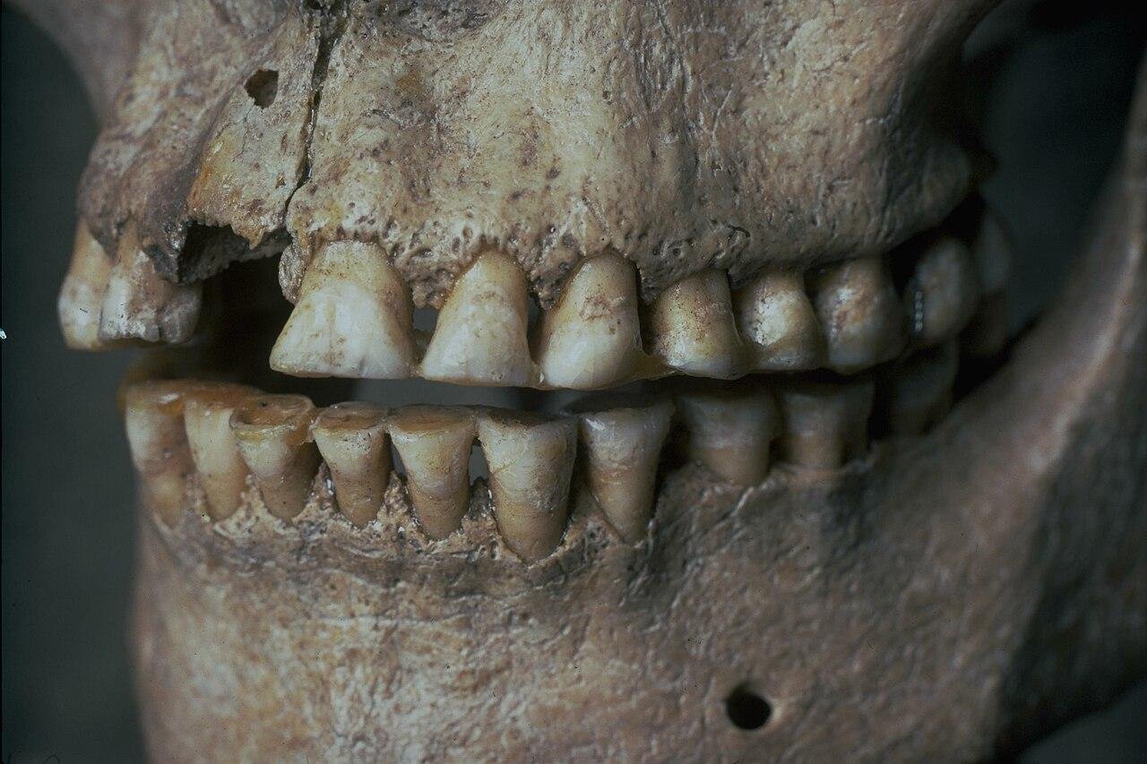 Ancient teeth reveal secrets of HSV-1 virus spread and evolution