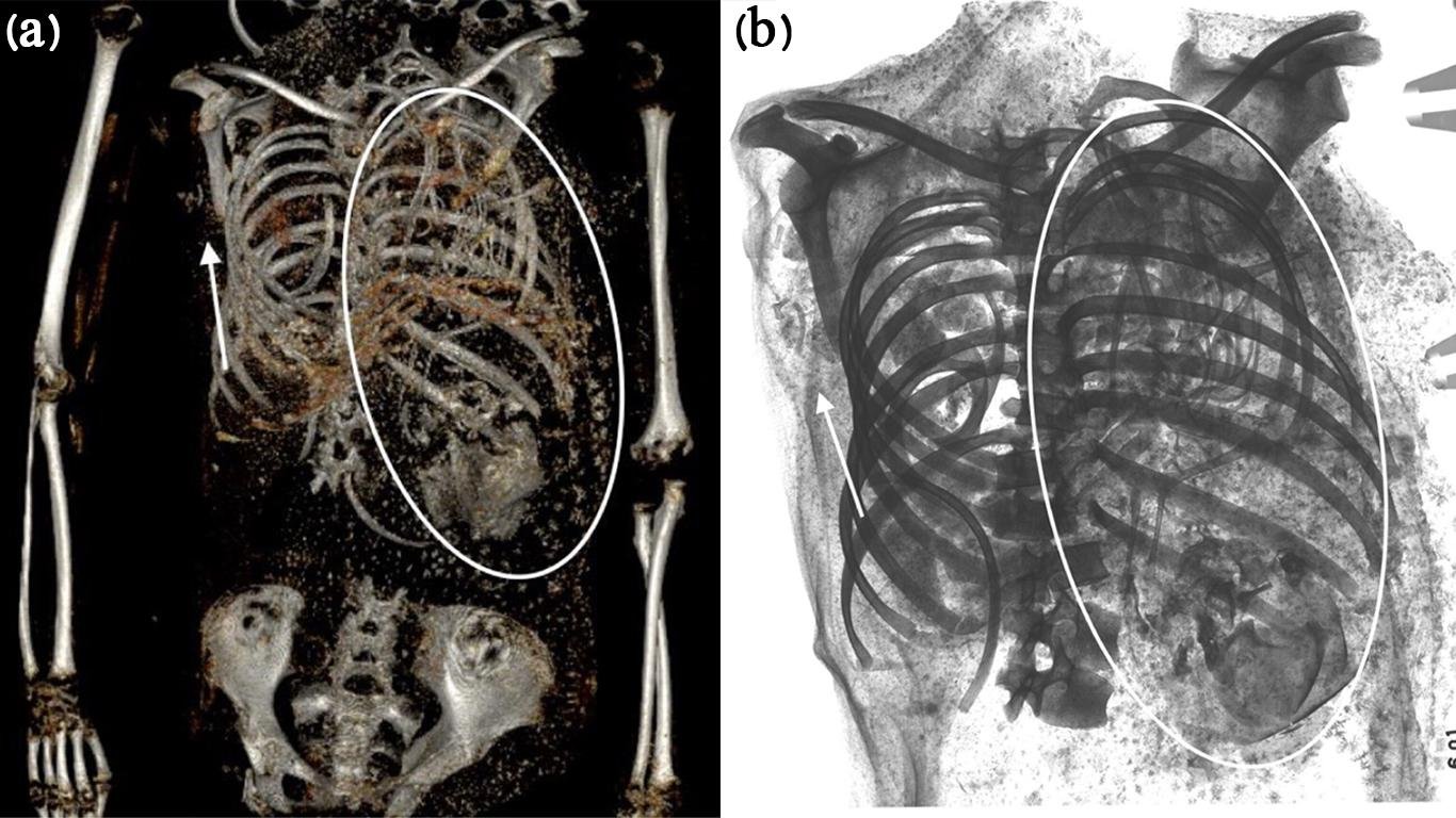 Shocking discovery of ancient Egyptian teen mom’s tragic childbirth