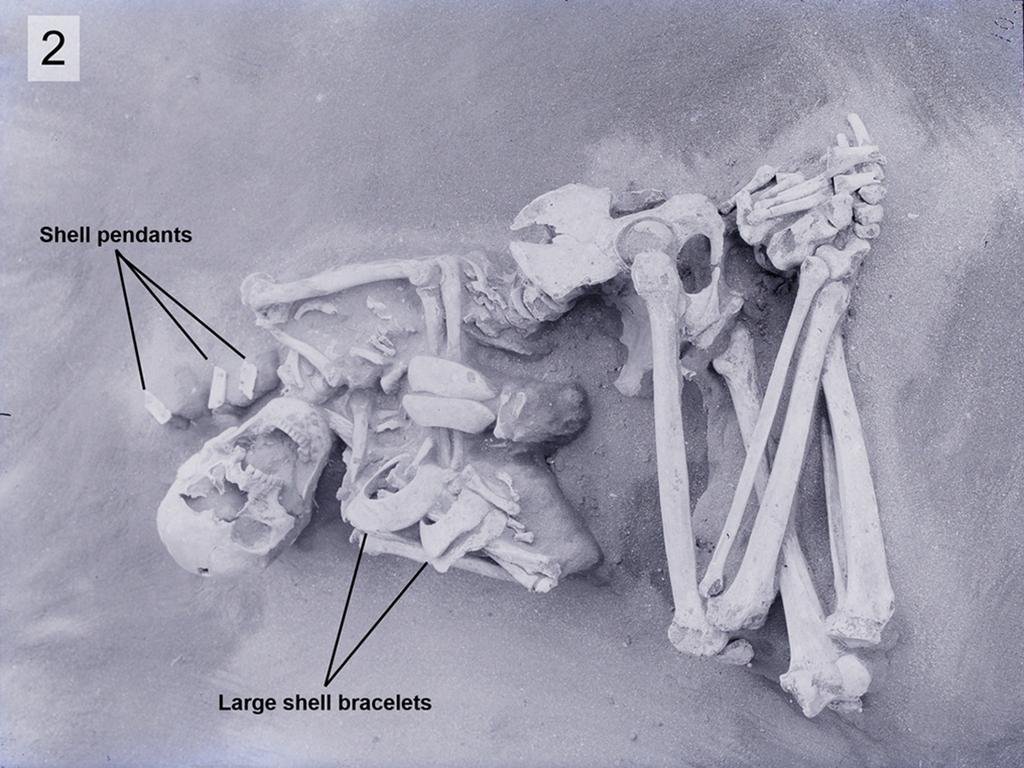 The mystery of cranial modification in ancient Japan is solved