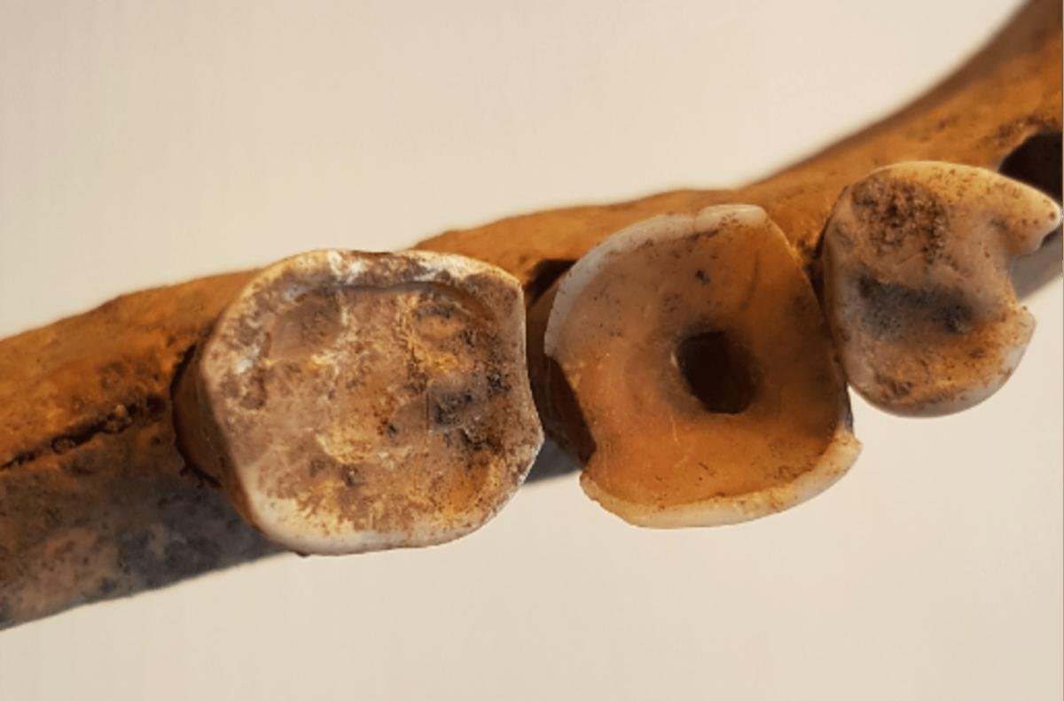 Uncovering advanced dentistry practices among Vikings