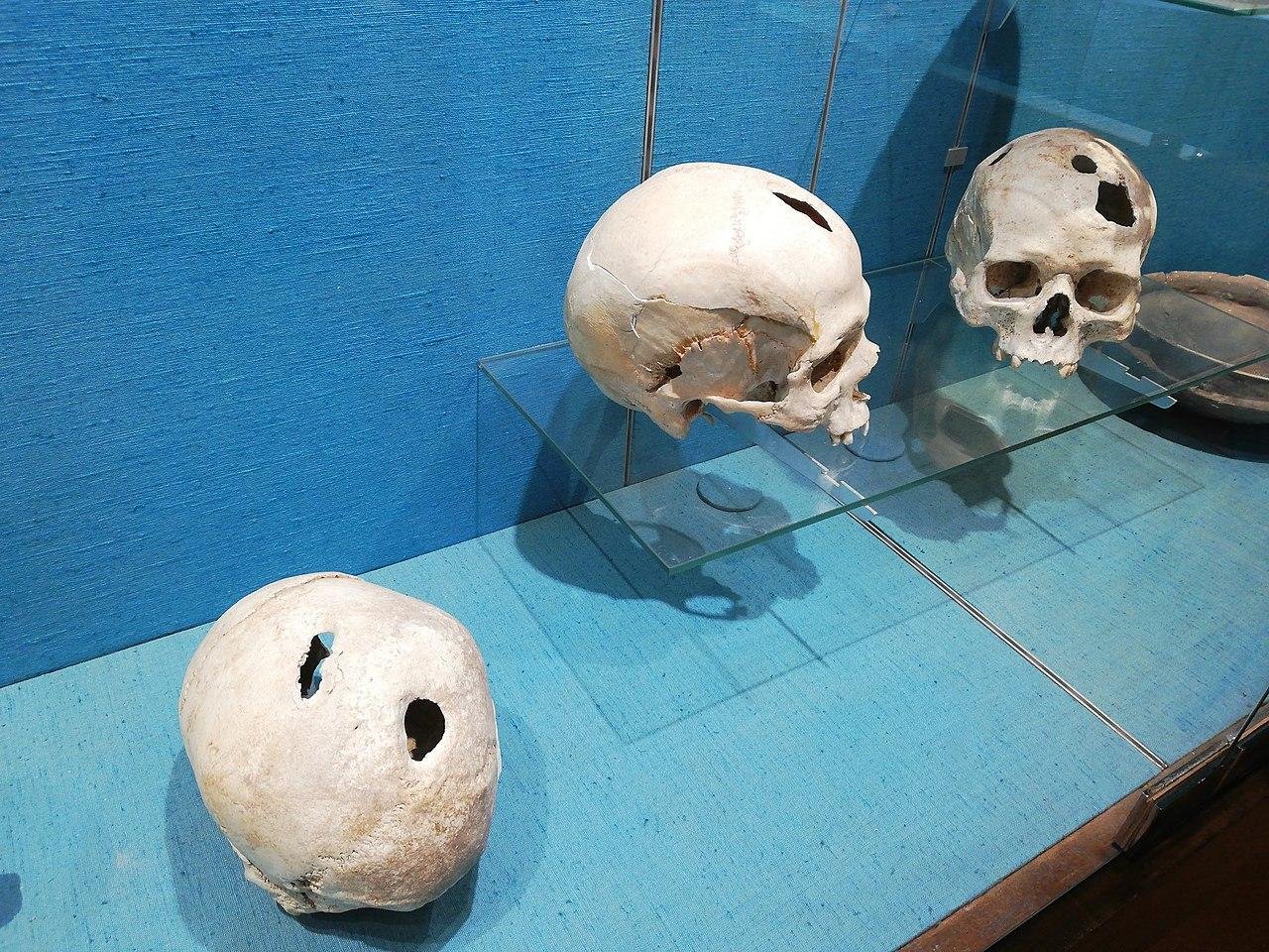 Traces of an ancient skull trepanation discovered in Çatalhöyük