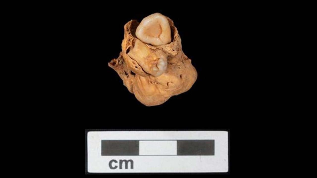 Oldest known case of teratoma discovered in Egyptian burial