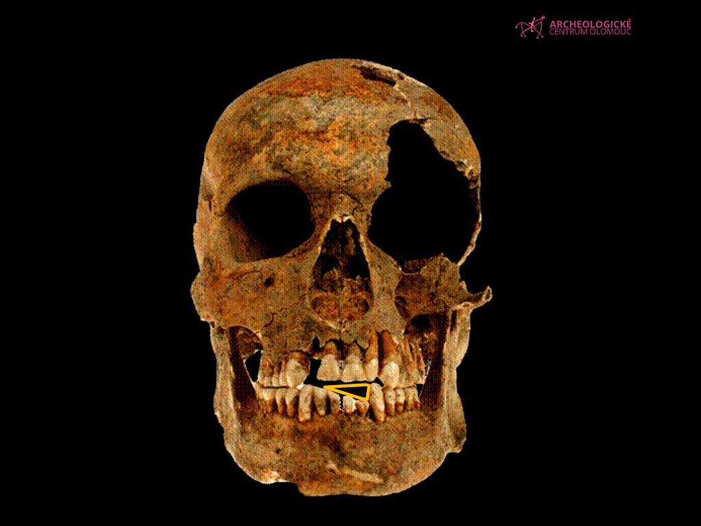 Scientists discover traces of military service on a 19th-century soldier’s teeth