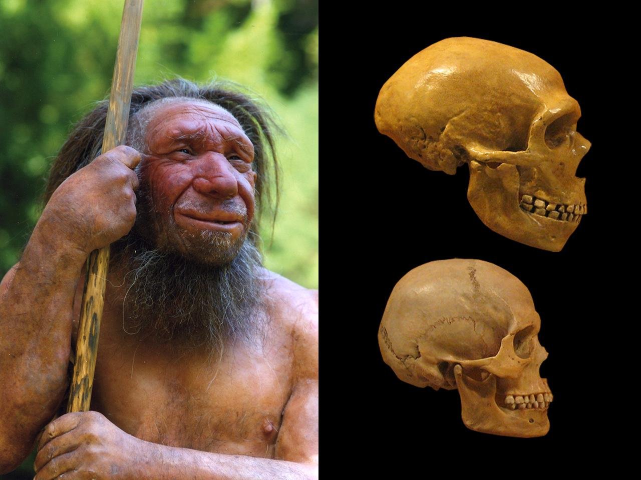 Neanderthal genes linked to rare brain-skull disorder, study finds