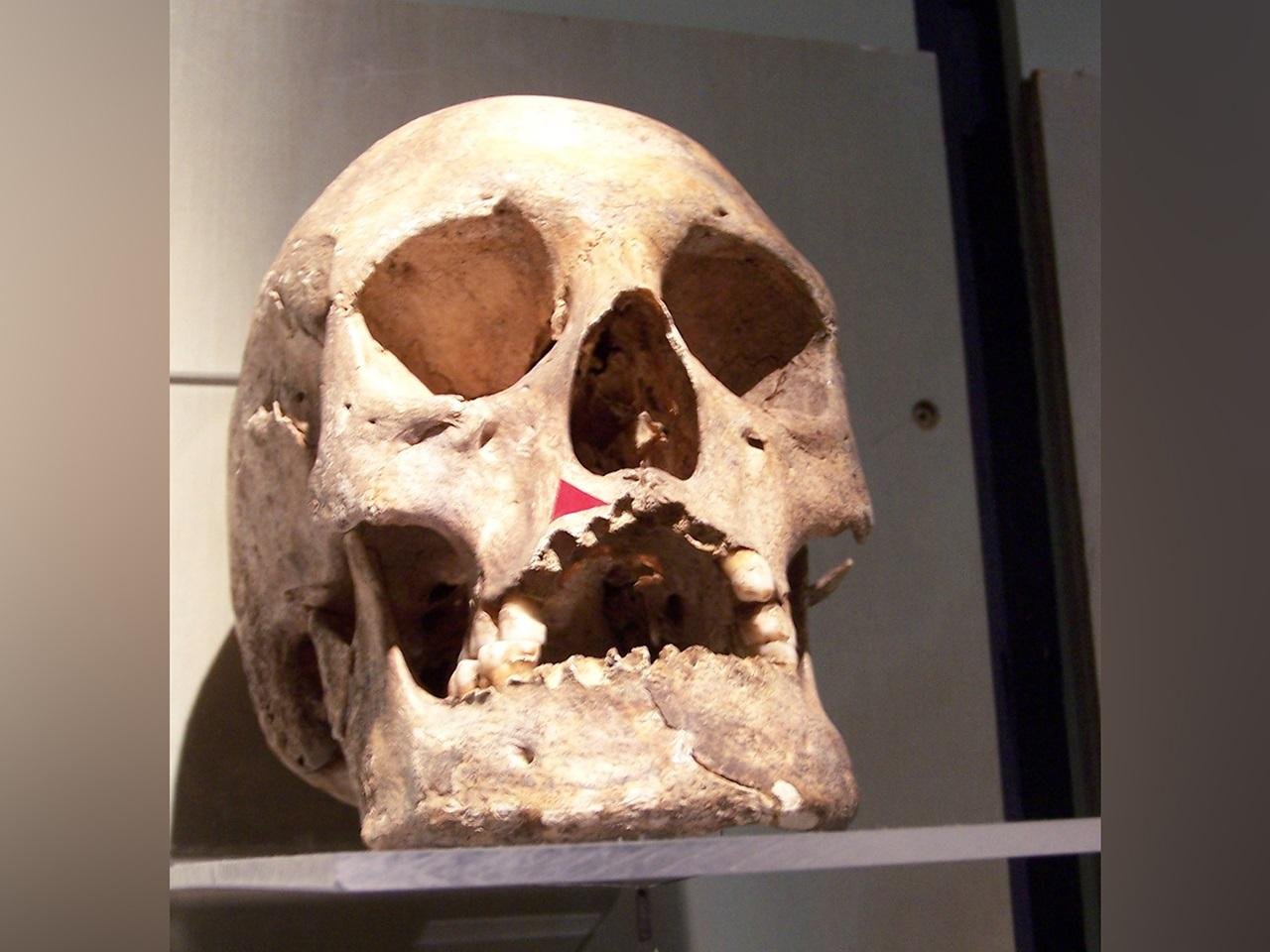 Ancient DNA reveals rare leprosy strain in the Americas thousands of years before European contact